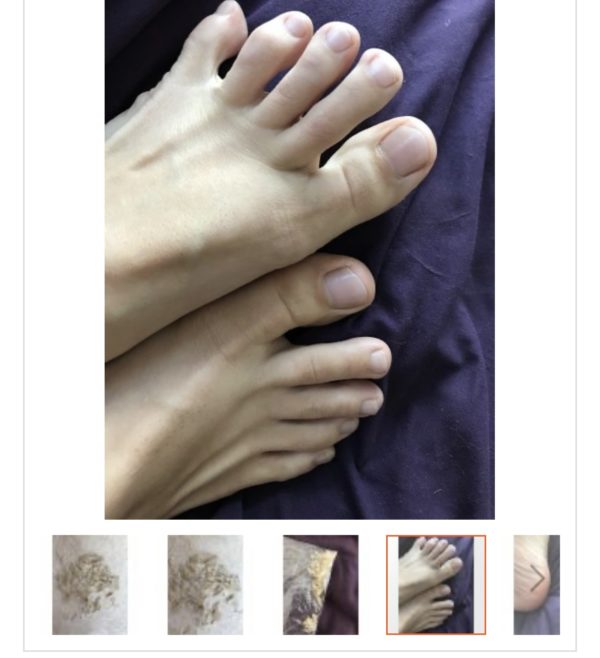 Foot shavings and toe nail clippings